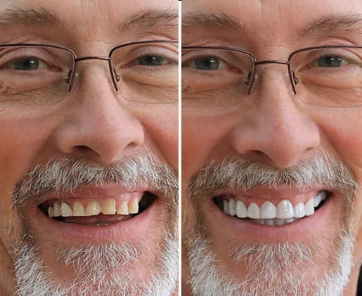 PurePearly™ Snap-On Veneers