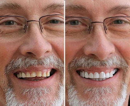 PurePearly™ Snap-On Veneers